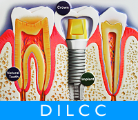 Dental Implant Laser Cosmetic Center (India)