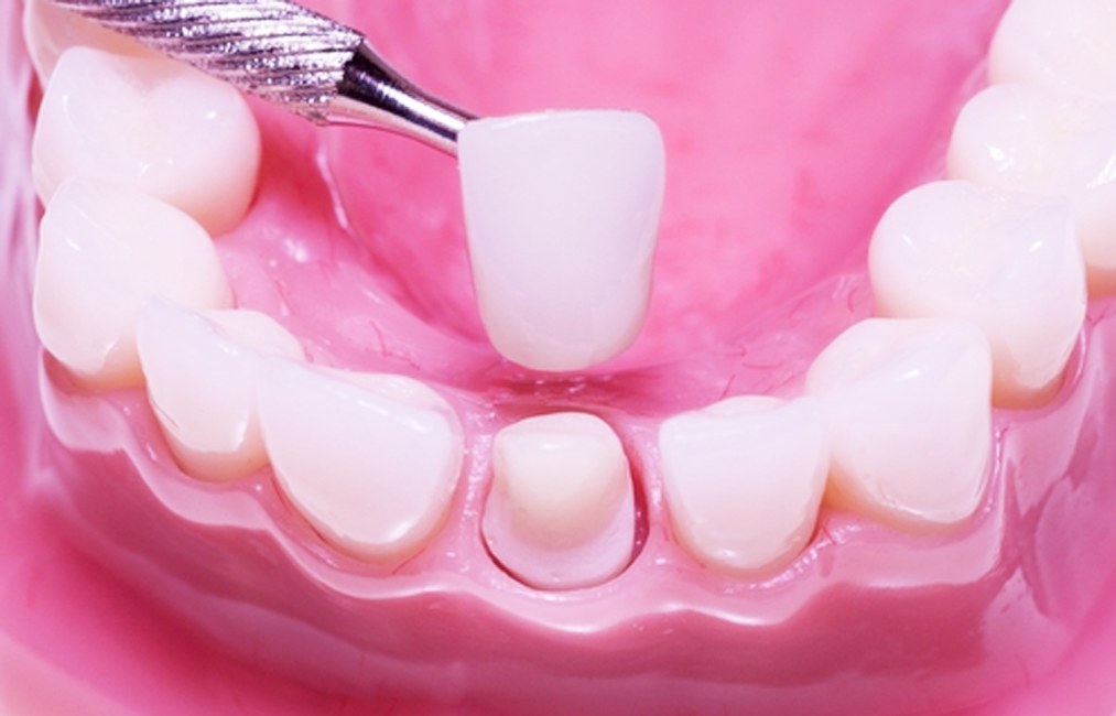 metal free crowns on dental implants