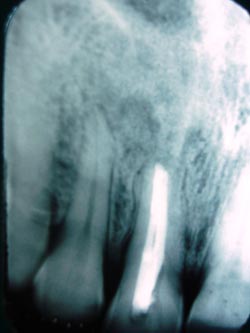 root canal therapy india